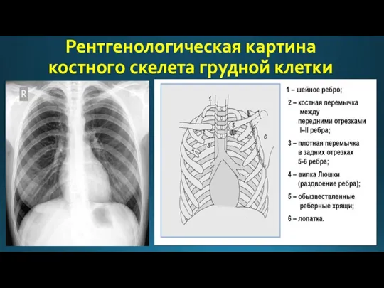 Рентгенологическая картина костного скелета грудной клетки