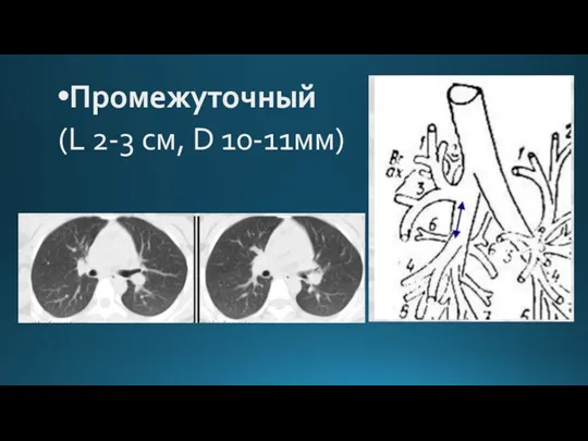 Промежуточный (L 2-3 см, D 10-11мм)