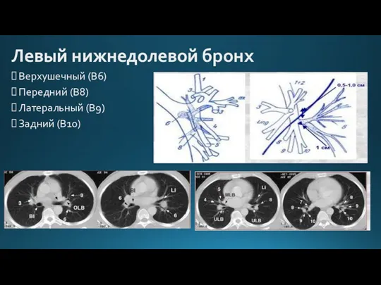 Левый нижнедолевой бронх Верхушечный (В6) Передний (В8) Латеральный (В9) Задний (В10)