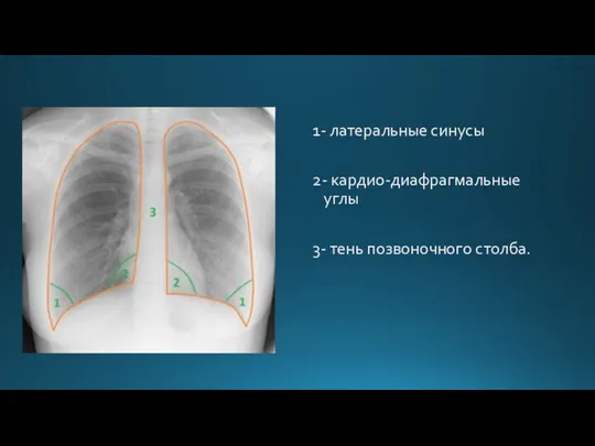 1- латеральные синусы 2- кардио-диафрагмальные углы 3- тень позвоночного столба.