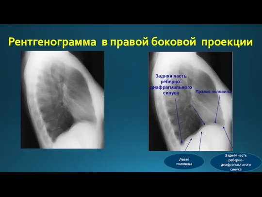 Рентгенограмма в правой боковой проекции Левая половина Задняя часть реберно-диафрагмального синуса