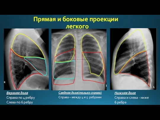 Верхняя доля Справа по 4 ребру Слева по 6 ребру