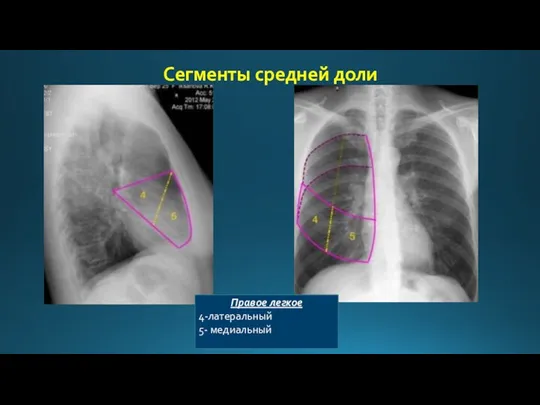 Сегменты средней доли Правое легкое 4-латеральный 5- медиальный