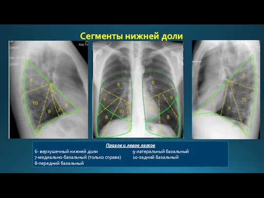 Сегменты нижней доли Правое и левое легкое 6- верхушечный нижней