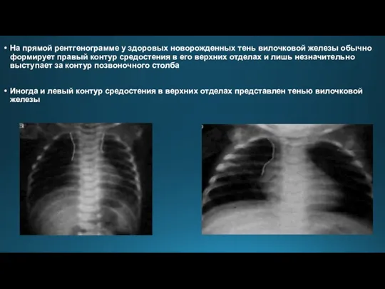 На прямой рентгенограмме у здоровых новорожденных тень вилочковой железы обычно формирует правый контур
