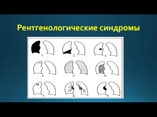 Рентгенологические синдромы