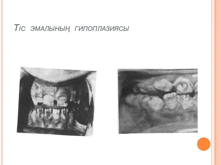 Тіс эмалының гипоплазиясы