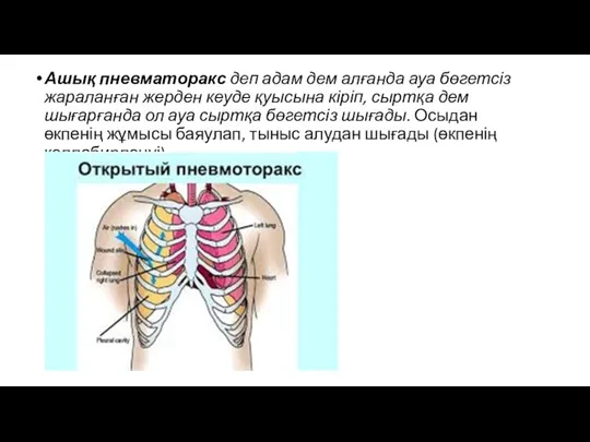 Ашық пневматоракс деп адам дем алғанда ауа бөгетсіз жараланған жерден кеуде қуысына кіріп,