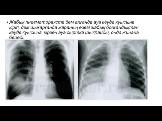 Жабық пневматоракста дем алғанда ауа кеуде қуысына кіріп, дем шығарғанда жараның өзегі жабық