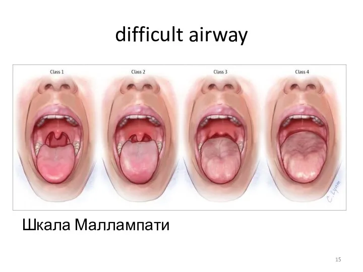 difficult airway Шкала Маллампати