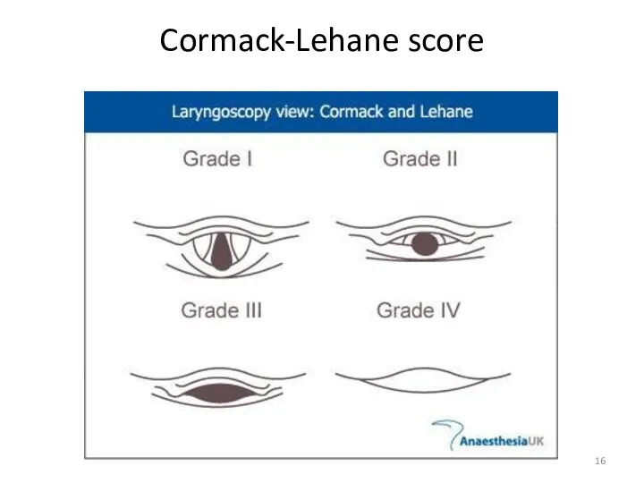 Cormack-Lehane score