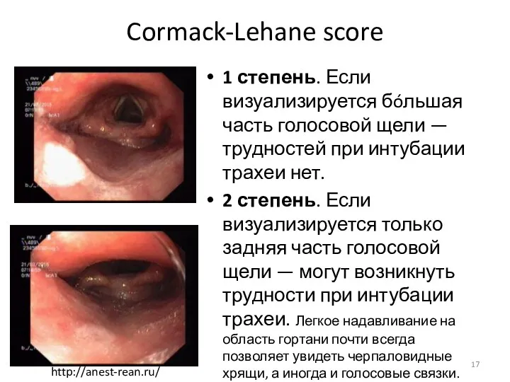 Cormack-Lehane score 1 степень. Если визуализируется бóльшая часть голосовой щели — трудностей при