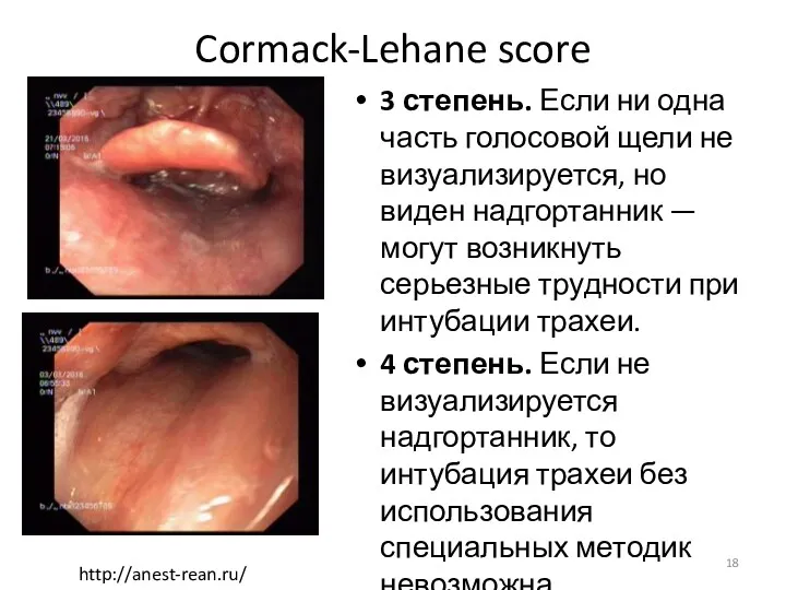 Cormack-Lehane score 3 степень. Если ни одна часть голосовой щели