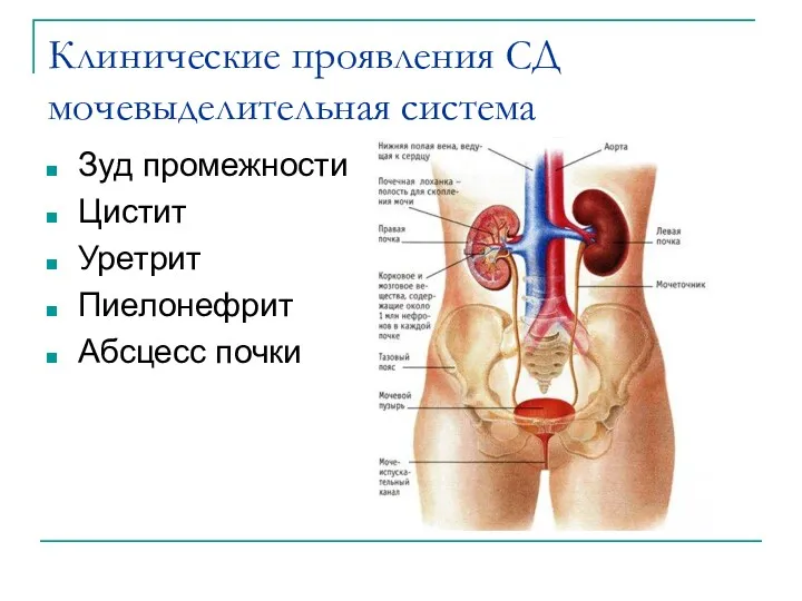 Клинические проявления СД мочевыделительная система Зуд промежности Цистит Уретрит Пиелонефрит Абсцесс почки