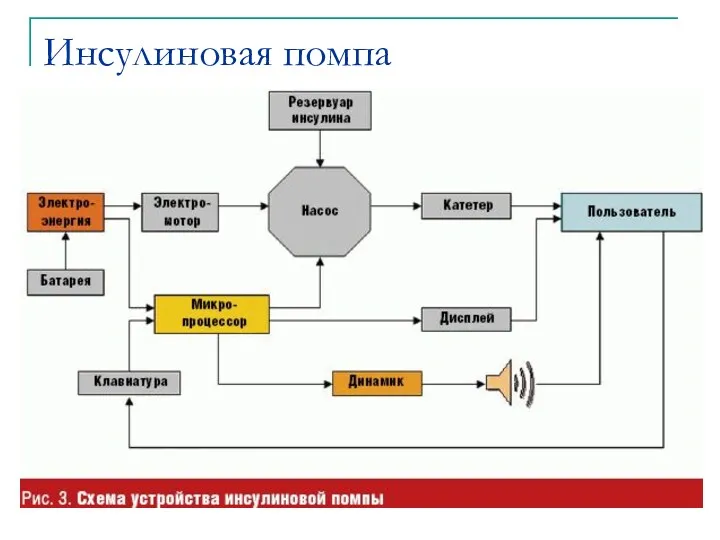 Инсулиновая помпа