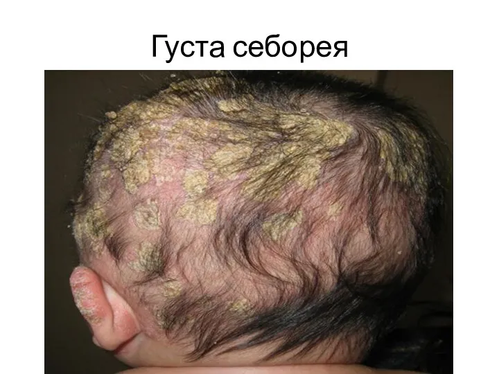 Густа себорея