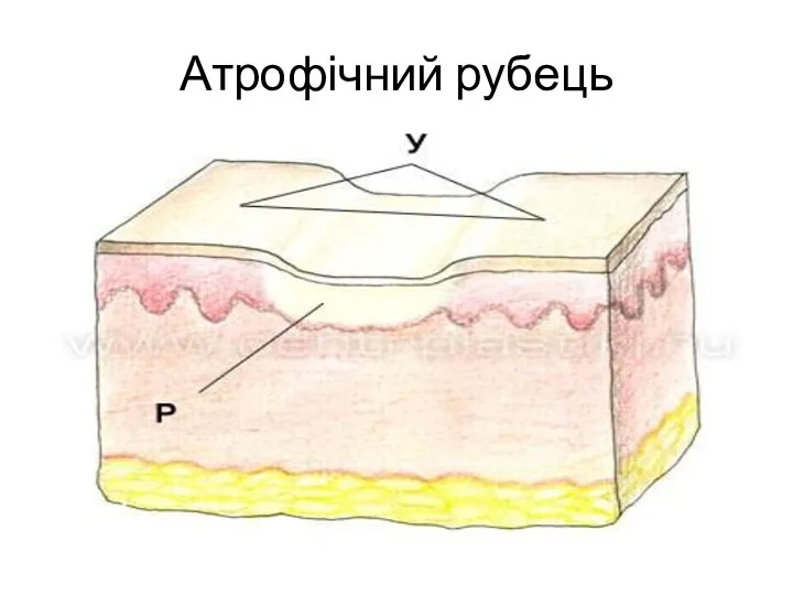 Атрофічний рубець