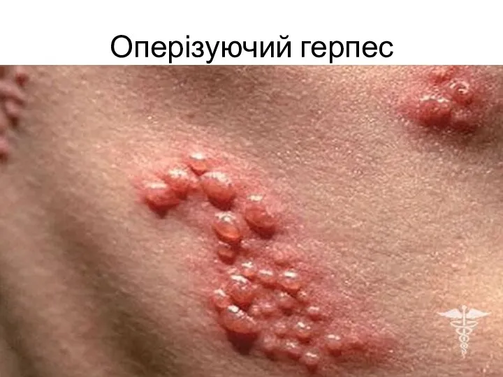 Оперізуючий герпес