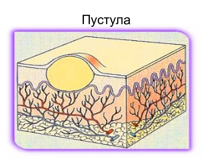 Пустула