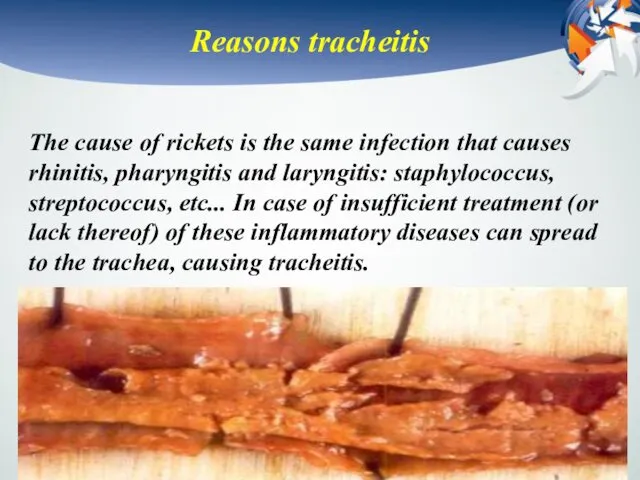 Reasons tracheitis The cause of rickets is the same infection