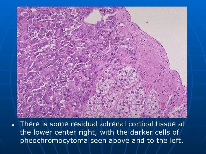 There is some residual adrenal cortical tissue at the lower