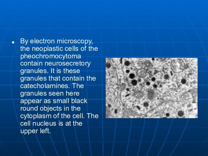 By electron microscopy, the neoplastic cells of the pheochromocytoma contain