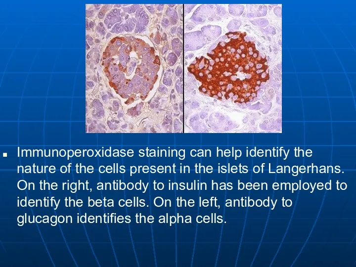 Immunoperoxidase staining can help identify the nature of the cells