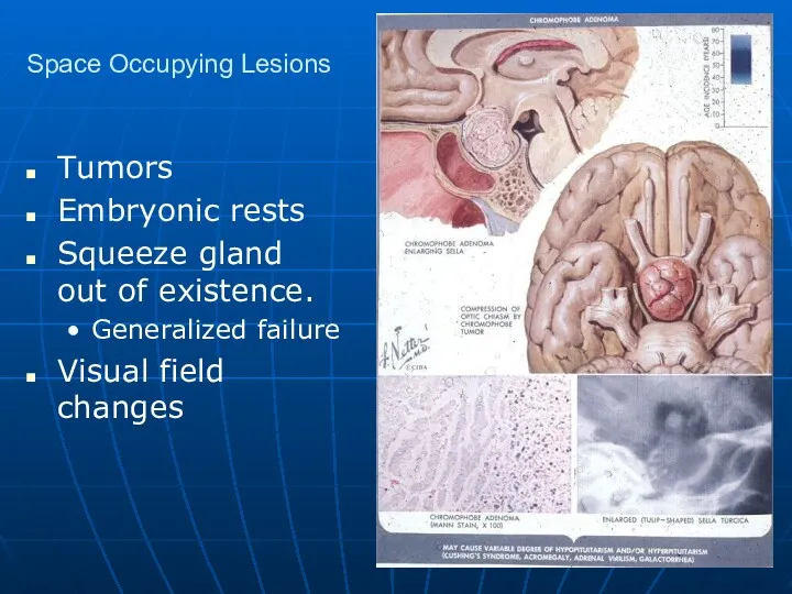 Space Occupying Lesions Tumors Embryonic rests Squeeze gland out of existence. Generalized failure Visual field changes