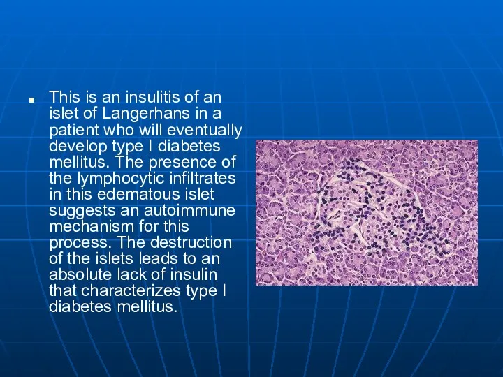 This is an insulitis of an islet of Langerhans in