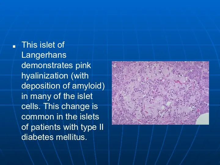 This islet of Langerhans demonstrates pink hyalinization (with deposition of