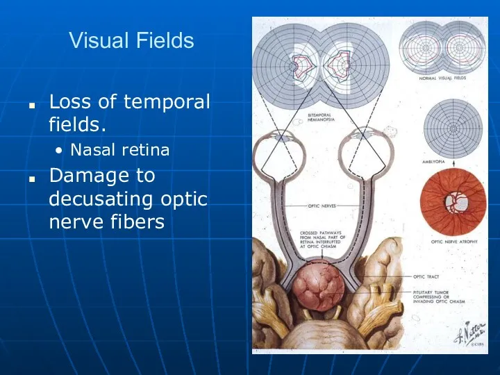 Visual Fields Loss of temporal fields. Nasal retina Damage to decusating optic nerve fibers