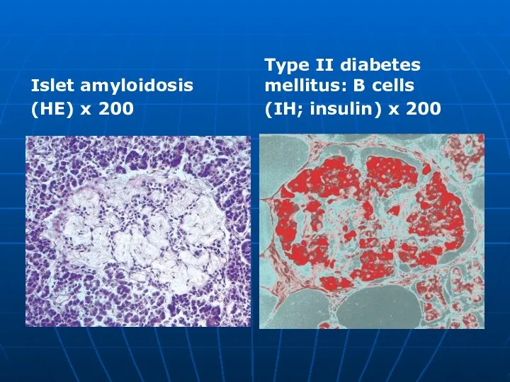 Islet amyloidosis (HE) x 200 Type II diabetes mellitus: В cells (IH; insulin) x 200