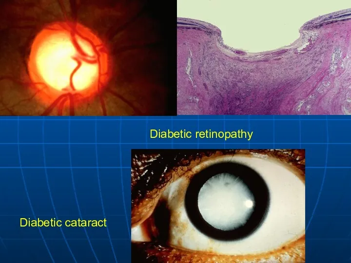 Diabetic retinopathy Diabetic cataract