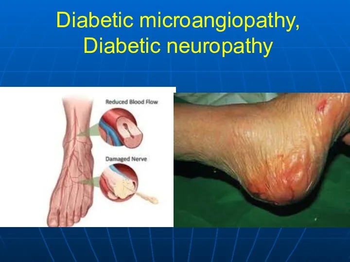 Diabetic microangiopathy, Diabetic neuropathy