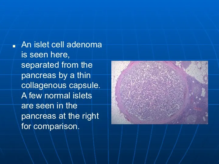 An islet cell adenoma is seen here, separated from the