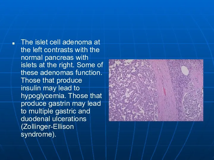 The islet cell adenoma at the left contrasts with the