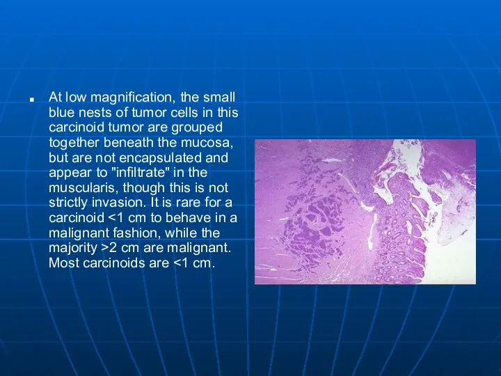 At low magnification, the small blue nests of tumor cells