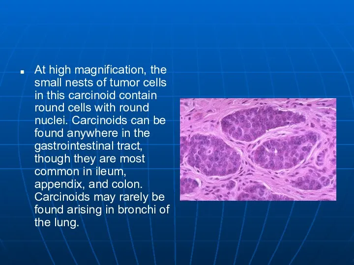 At high magnification, the small nests of tumor cells in