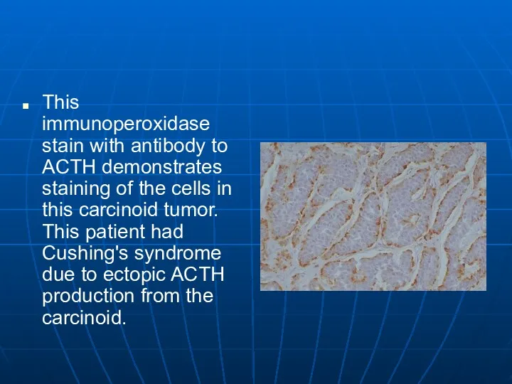 This immunoperoxidase stain with antibody to ACTH demonstrates staining of