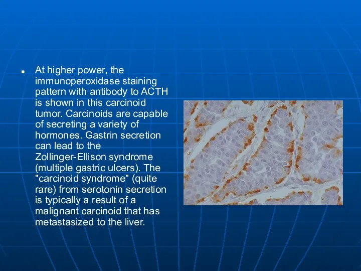 At higher power, the immunoperoxidase staining pattern with antibody to