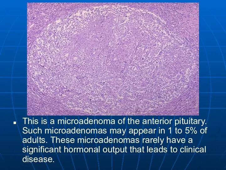 This is a microadenoma of the anterior pituitary. Such microadenomas