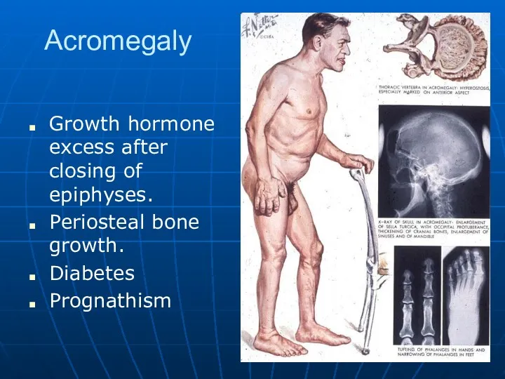 Acromegaly Growth hormone excess after closing of epiphyses. Periosteal bone growth. Diabetes Prognathism