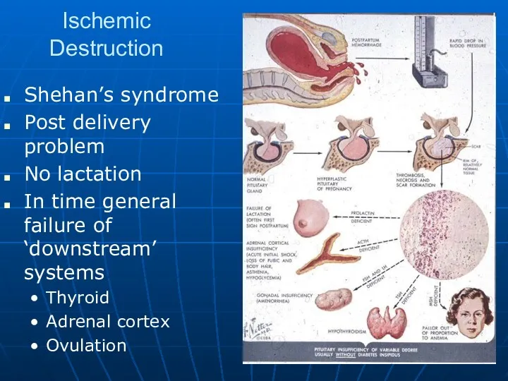 Ischemic Destruction Shehan’s syndrome Post delivery problem No lactation In