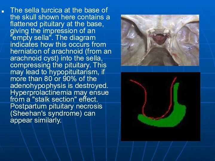 The sella turcica at the base of the skull shown