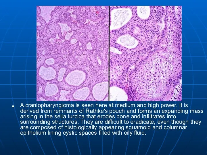 A craniopharyngioma is seen here at medium and high power.