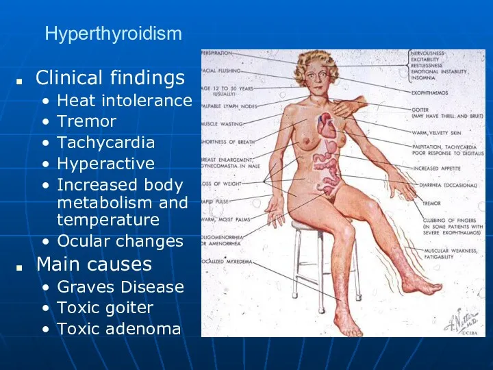 Hyperthyroidism Clinical findings Heat intolerance Tremor Tachycardia Hyperactive Increased body