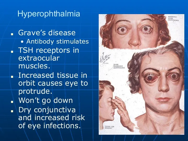 Hyperophthalmia Grave’s disease Antibody stimulates TSH receptors in extraocular muscles.