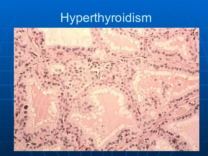 Hyperthyroidism