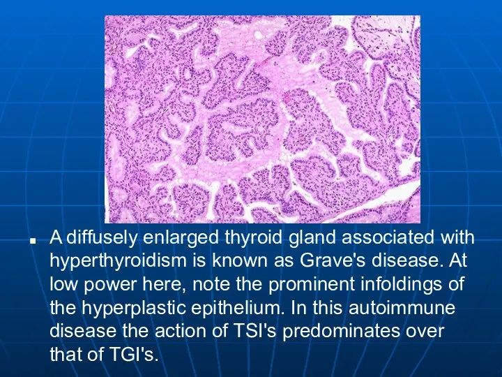 A diffusely enlarged thyroid gland associated with hyperthyroidism is known