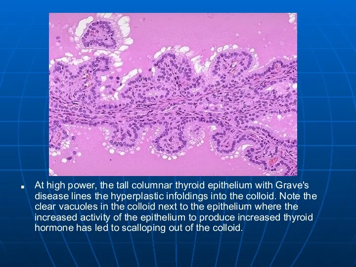 At high power, the tall columnar thyroid epithelium with Grave's